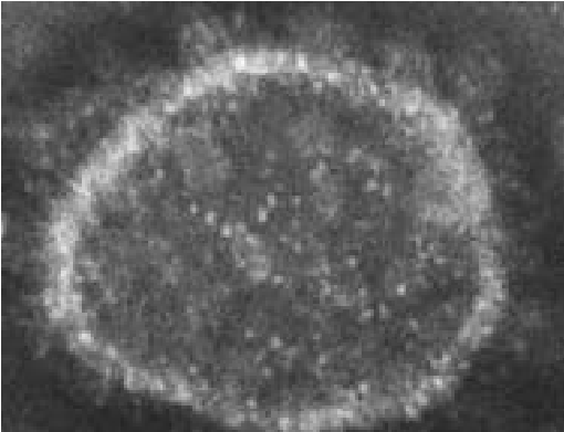 Αναπνευστικός Συγκυτιακός Ιός (RSV)